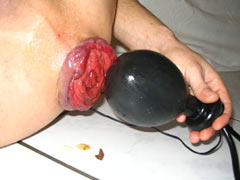 The most painful saline injection